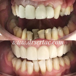 Porselen diş kaplama zirkonyum diş kaplama arasındaki fark