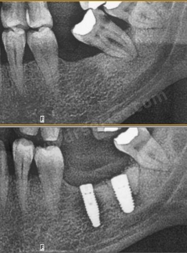 Diş çekiminden hemen sonra yapılan implant etrafına kemik tozu uygulaması. Dİş Hekimi Sertaç Kızılkaya