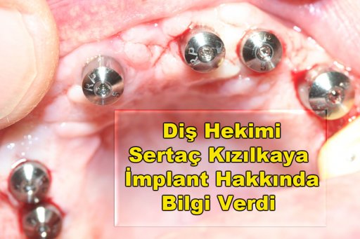 İmplant diş yapımı e implant fiyatları