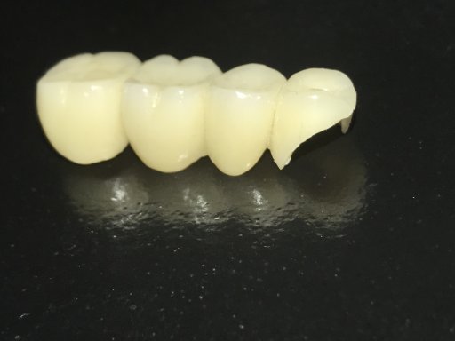 Zirkonyum diş kaplama malzeme olarak çiğneme kuvvetlerine karşı dayanıklıdır.