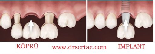 Tek diş eksikliğinde köprü ve implant yapımı