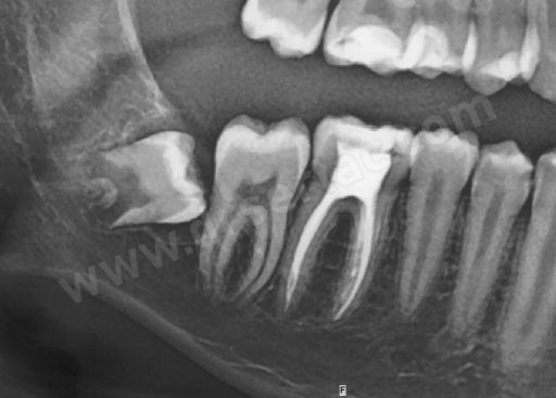 Gömük yirmilik diş ve kanal tedavisi